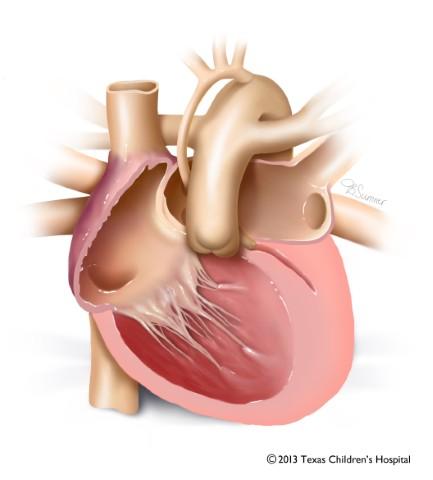 健康・医学 Hypoplastic Left Heart Syndrome Causes and Symptoms of Hypoplastic Left Heart Syndrome